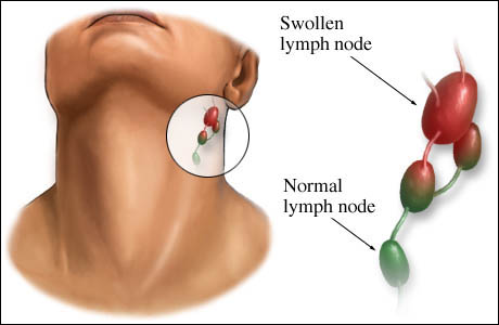 Swollen Lymph Nodes