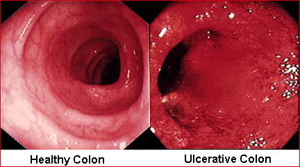 ulcerative colitis, ulcers, colon